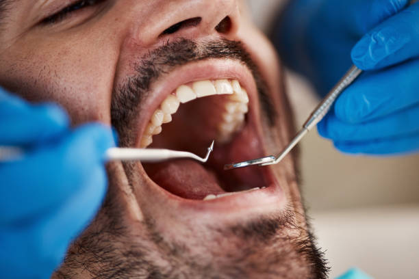 Best Same-Day Emergency Dentist in Rm Beach, WA
